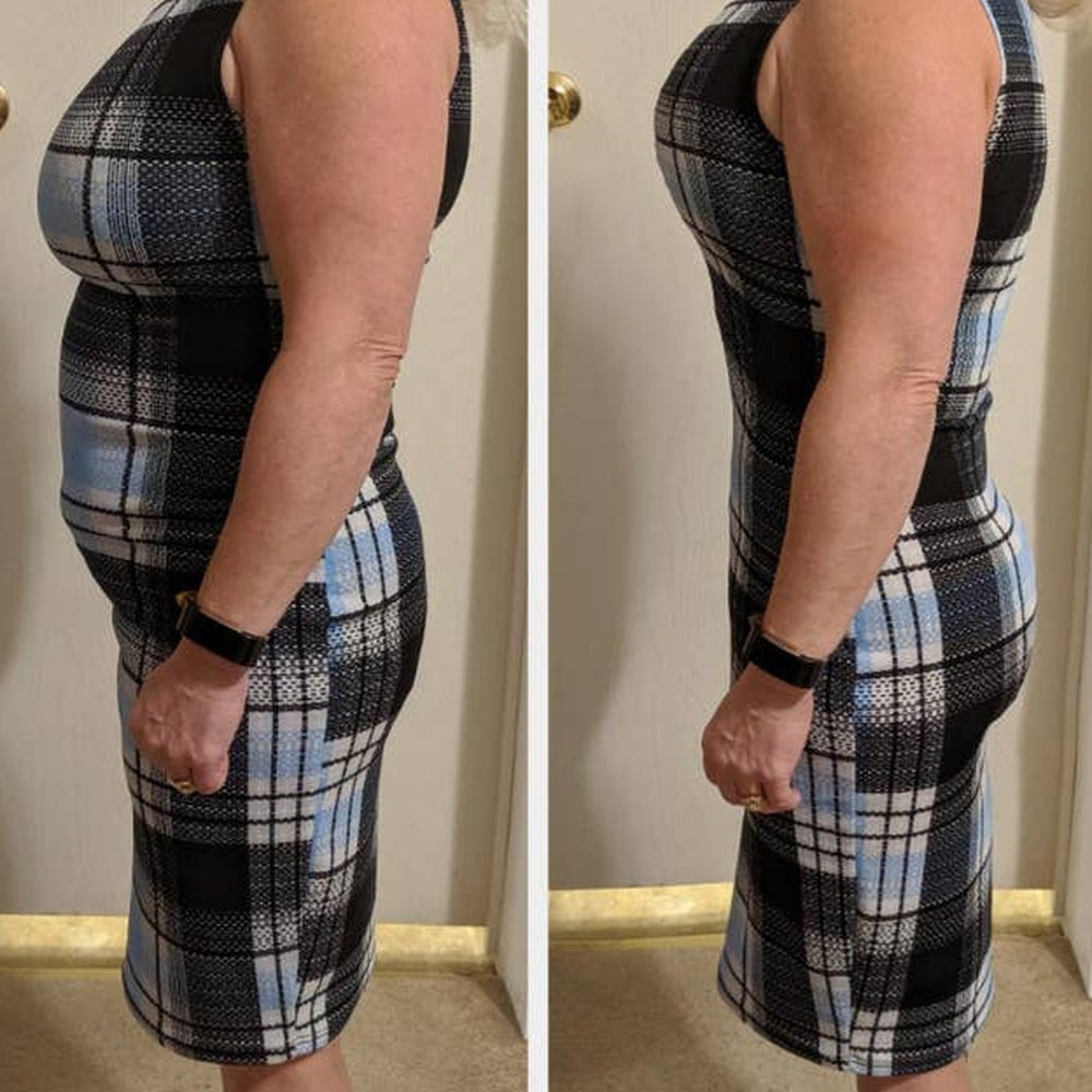 Side views of a woman in a fitted dress showing a smoother tummy line